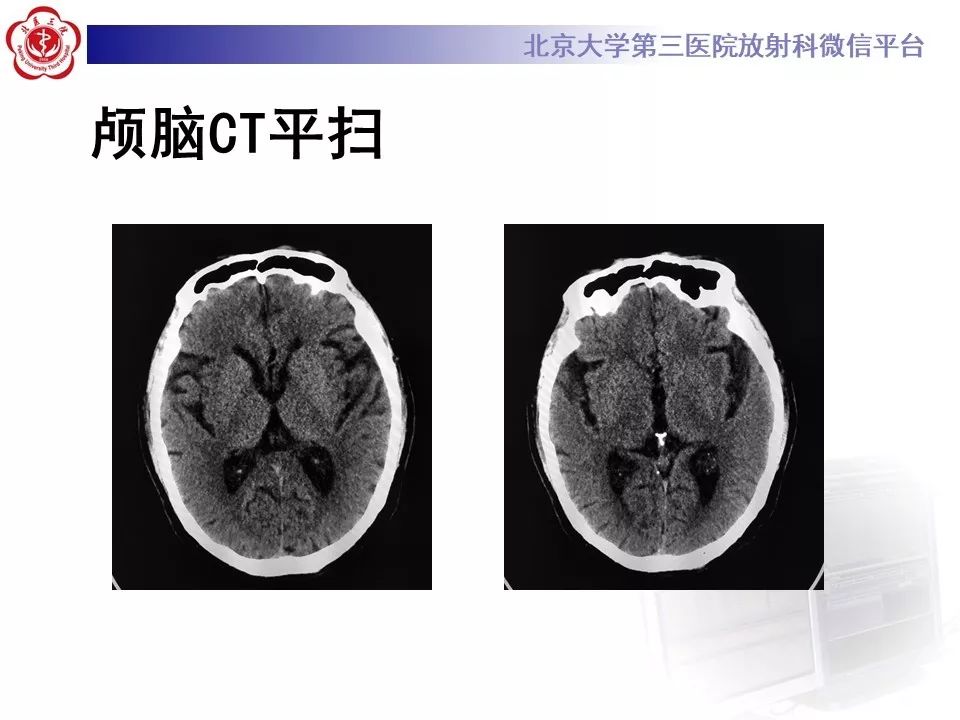 【PPT】脉络丛黄色肉芽肿的影像