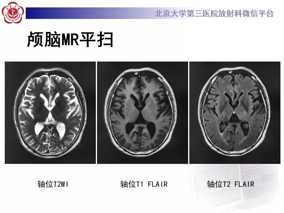 【PPT】脉络丛黄色肉芽肿的影像