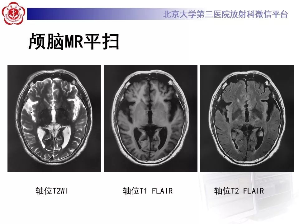 【PPT】脉络丛黄色肉芽肿的影像