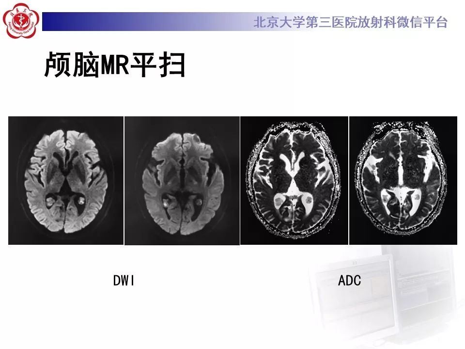 【PPT】脉络丛黄色肉芽肿的影像
