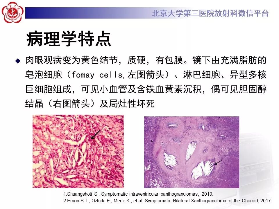 【PPT】脉络丛黄色肉芽肿的影像
