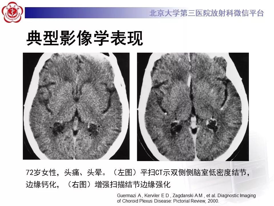 【PPT】脉络丛黄色肉芽肿的影像