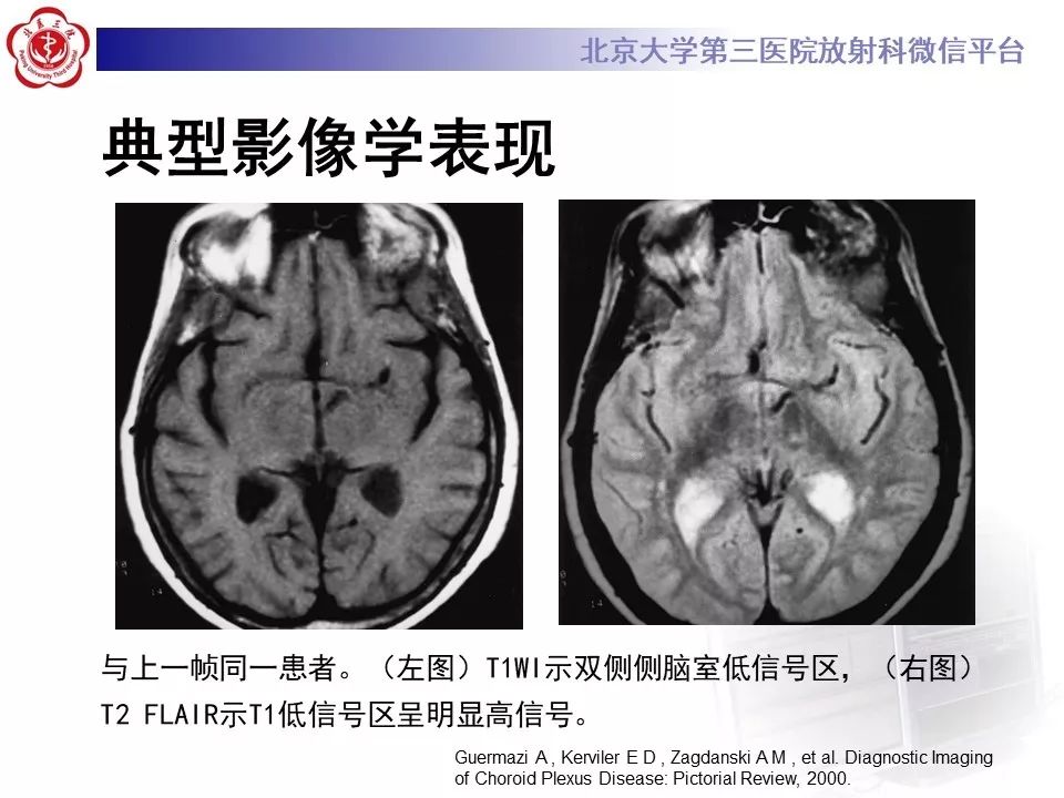 【PPT】脉络丛黄色肉芽肿的影像