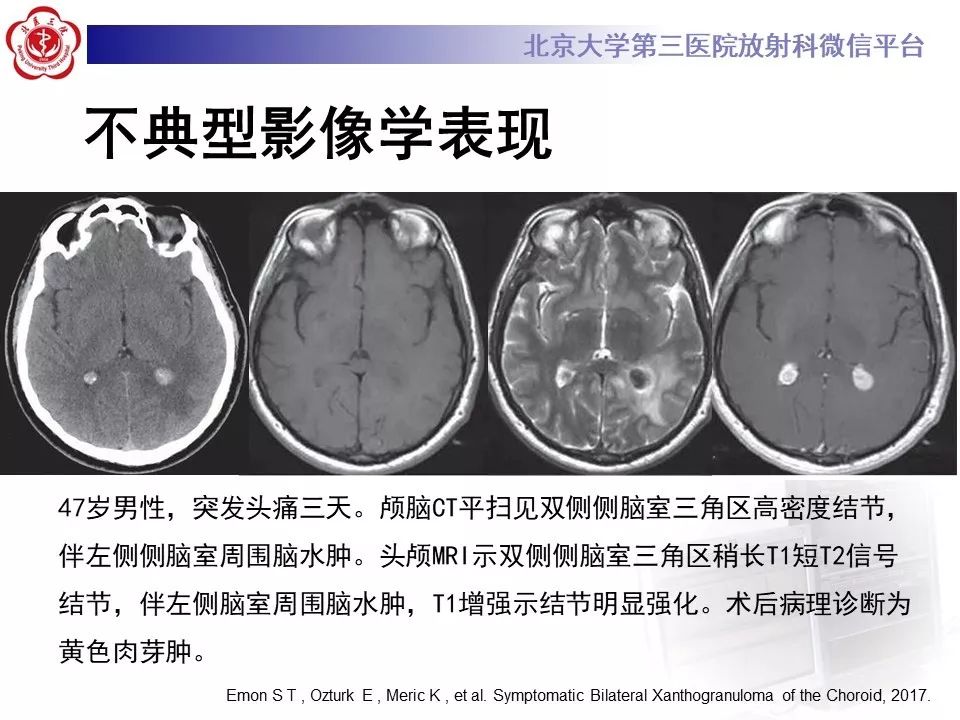 【PPT】脉络丛黄色肉芽肿的影像