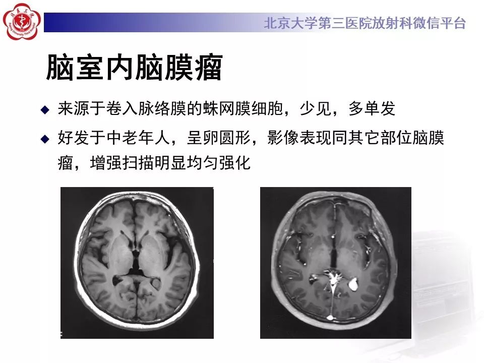 【PPT】脉络丛黄色肉芽肿的影像