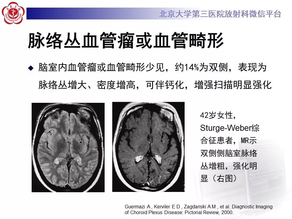 【PPT】脉络丛黄色肉芽肿的影像