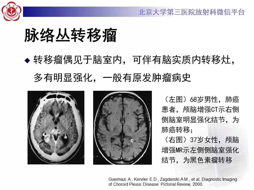 【PPT】脉络丛黄色肉芽肿的影像