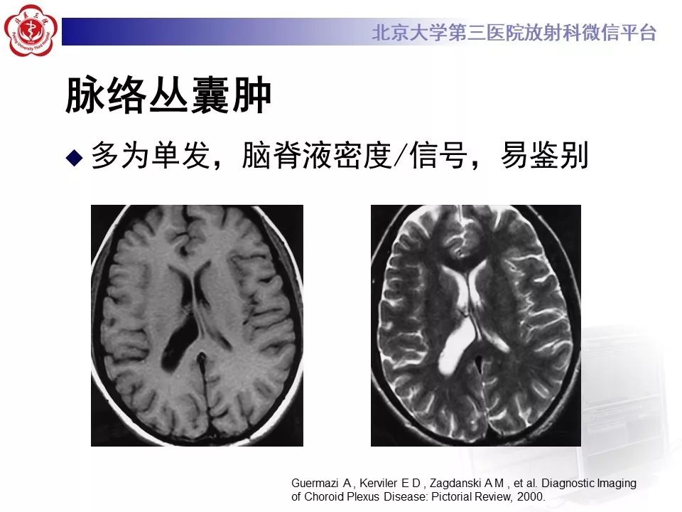 【PPT】脉络丛黄色肉芽肿的影像