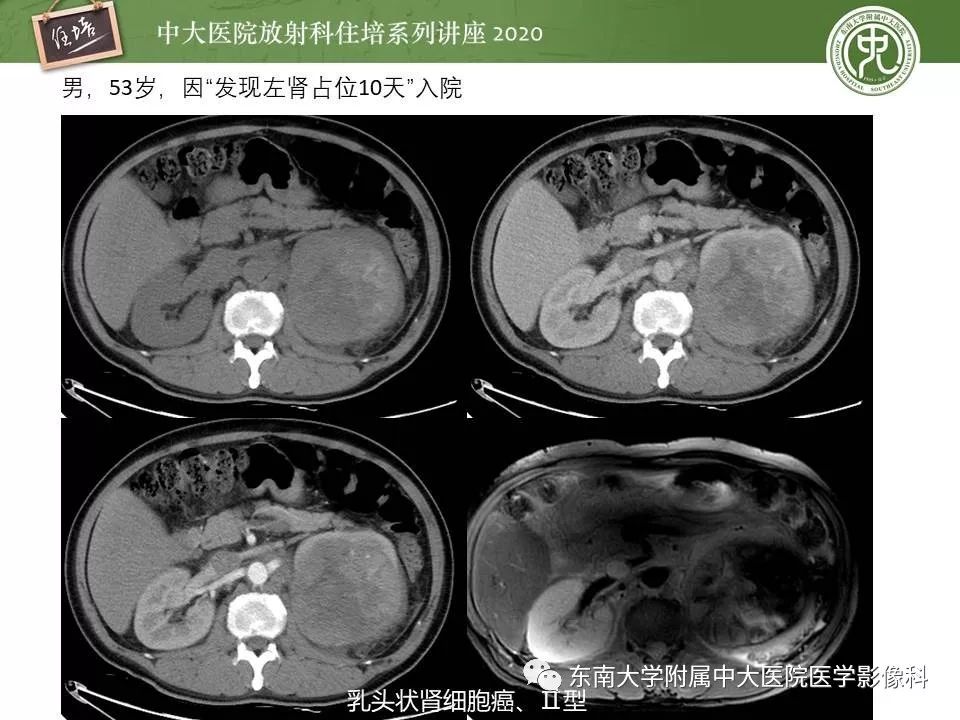 【PPT】肾脏乏血供占位的影像学诊断