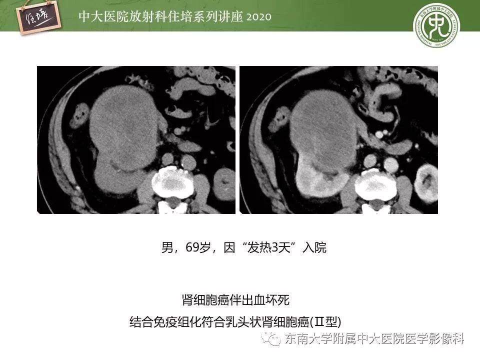【PPT】肾脏乏血供占位的影像学诊断