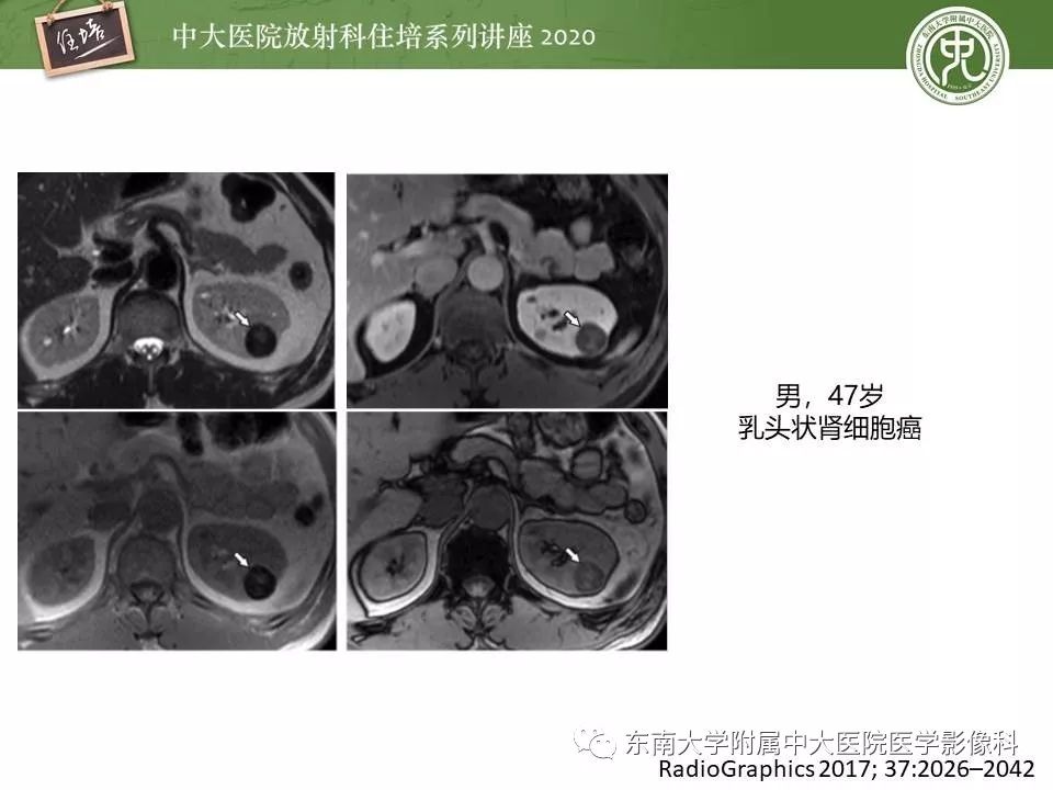 【PPT】肾脏乏血供占位的影像学诊断
