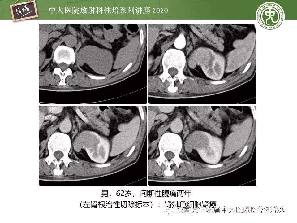 【PPT】肾脏乏血供占位的影像学诊断