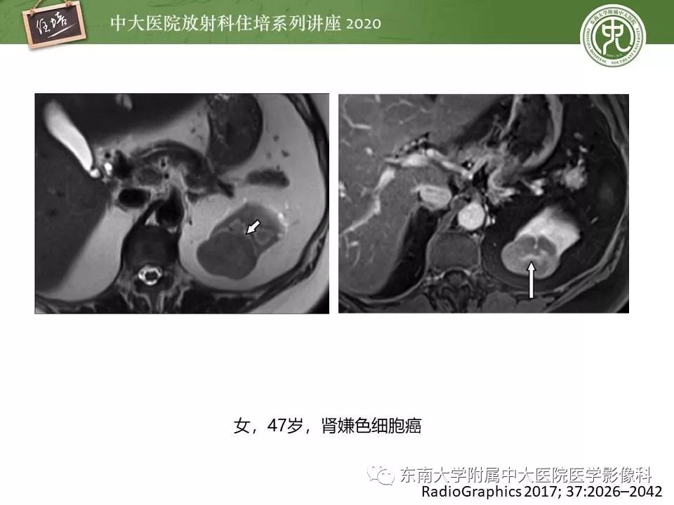 【PPT】肾脏乏血供占位的影像学诊断