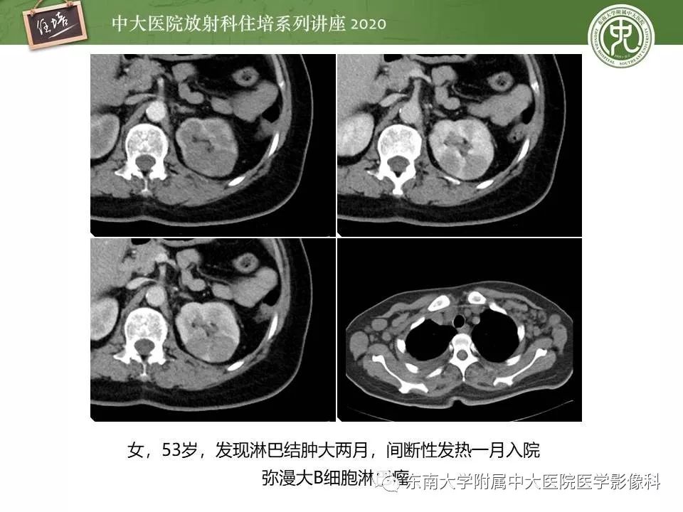 【PPT】肾脏乏血供占位的影像学诊断