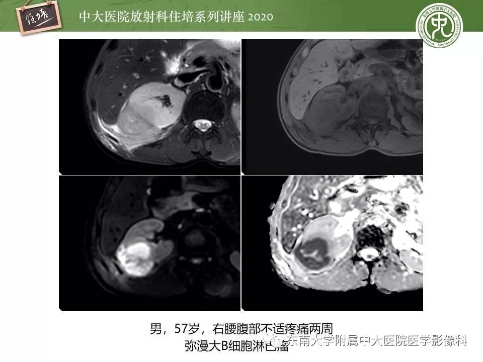 【PPT】肾脏乏血供占位的影像学诊断