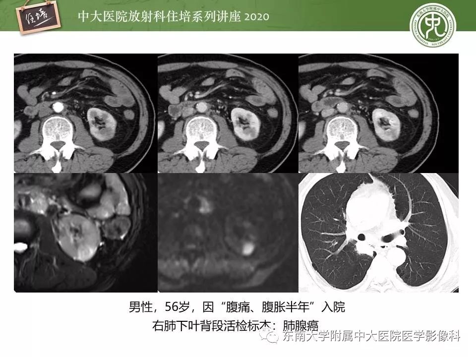 【PPT】肾脏乏血供占位的影像学诊断