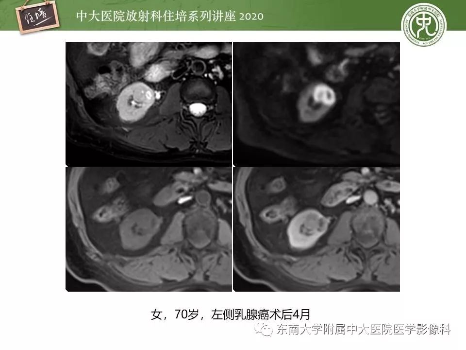 【PPT】肾脏乏血供占位的影像学诊断