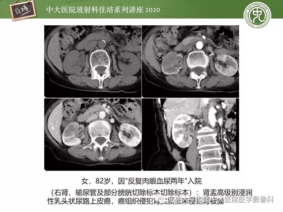 【PPT】肾脏乏血供占位的影像学诊断