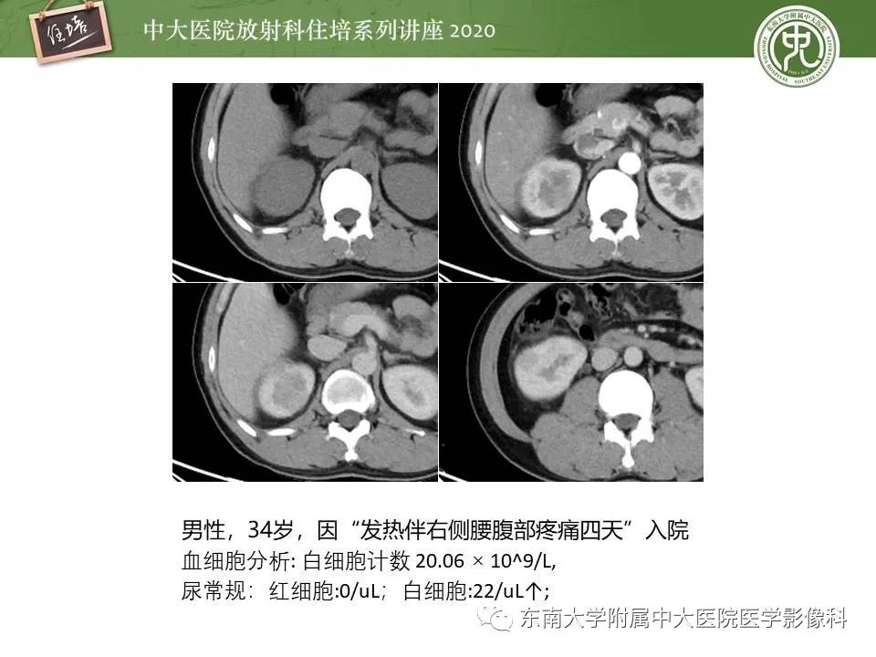 【PPT】肾脏乏血供占位的影像学诊断
