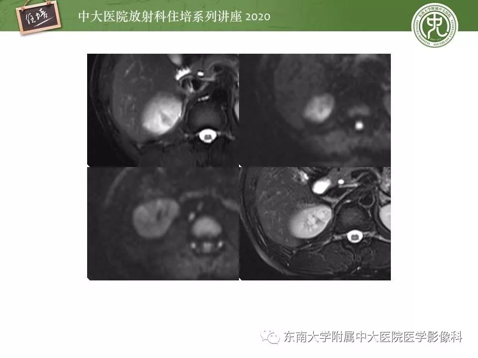【PPT】肾脏乏血供占位的影像学诊断