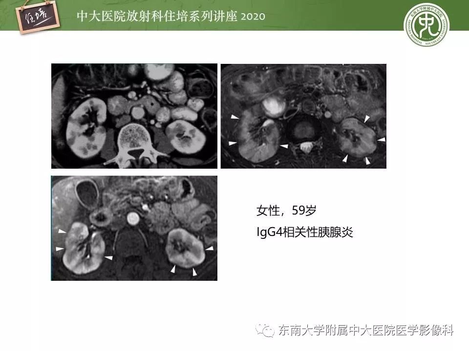 【PPT】肾脏乏血供占位的影像学诊断