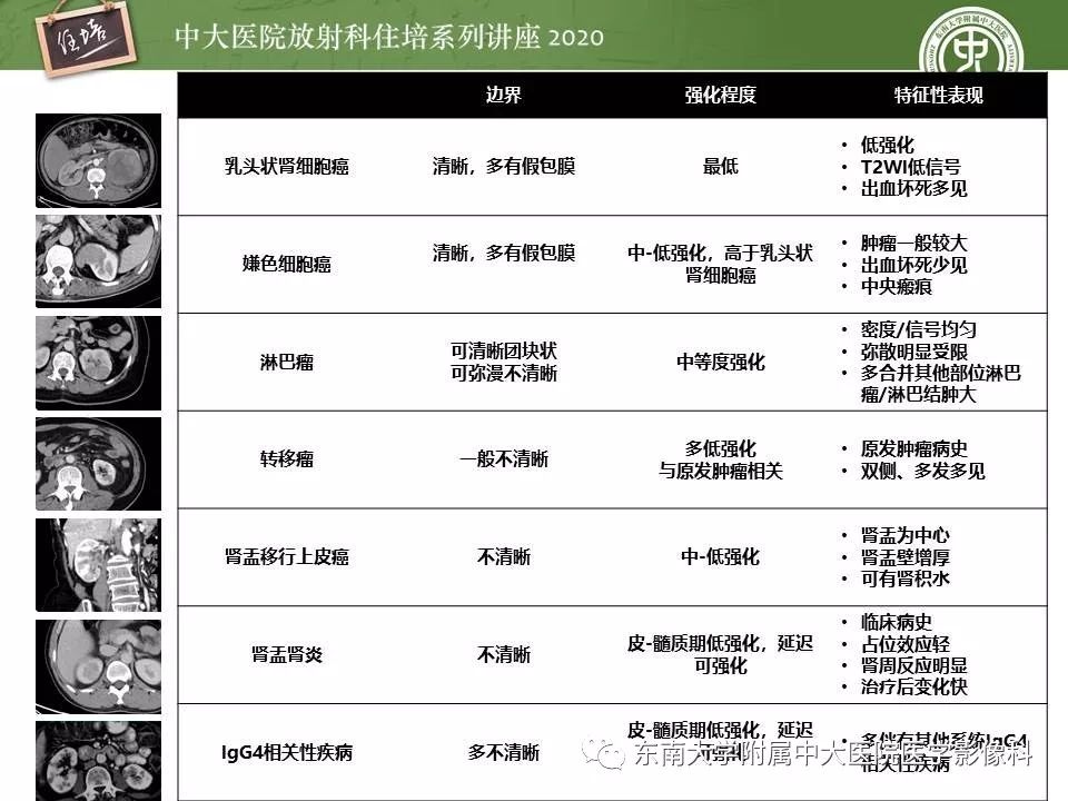 【PPT】肾脏乏血供占位的影像学诊断