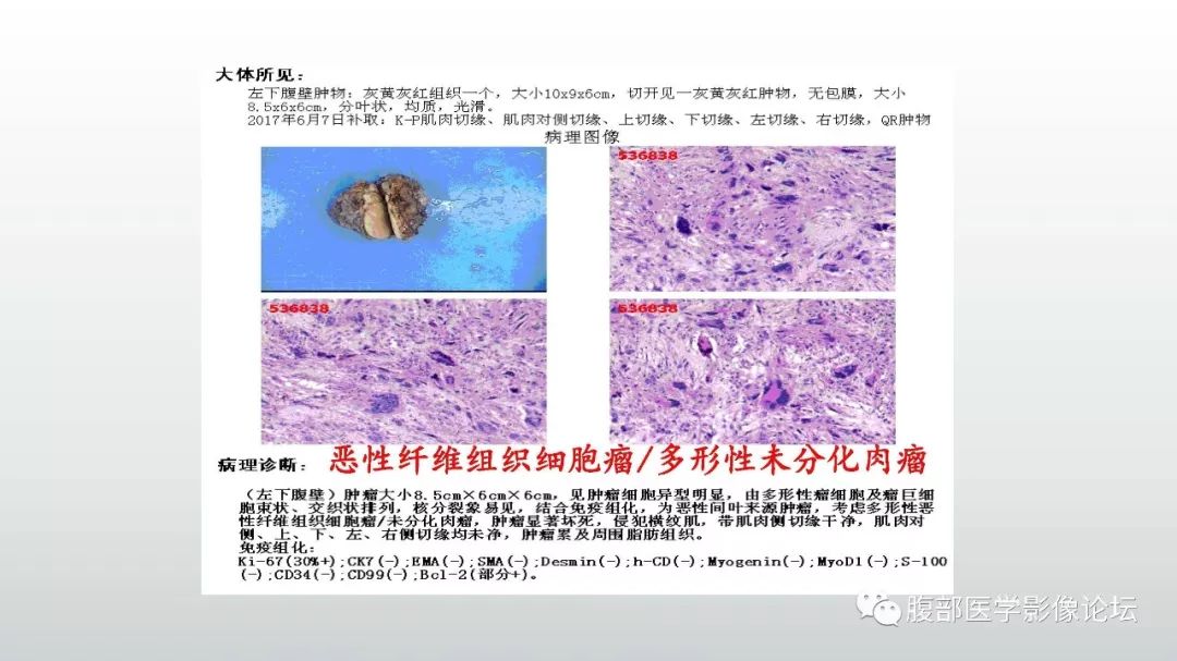 【病例】左下腹壁未分化多形性肉瘤1例CT影像