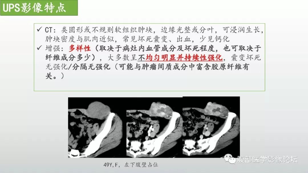 【病例】左下腹壁未分化多形性肉瘤1例CT影像