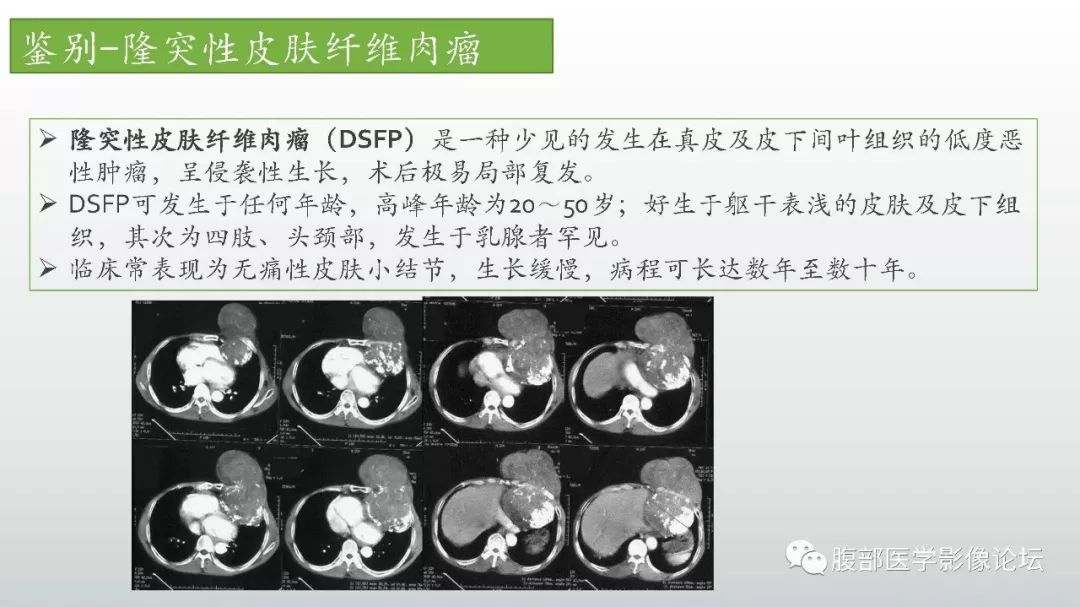 【病例】左下腹壁未分化多形性肉瘤1例CT影像