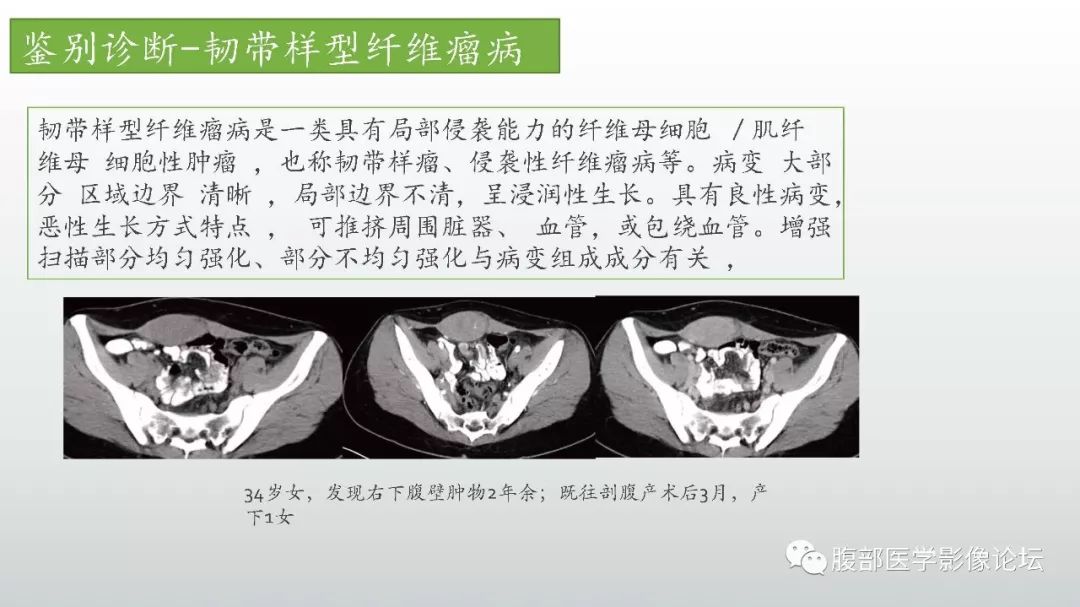 【病例】左下腹壁未分化多形性肉瘤1例CT影像