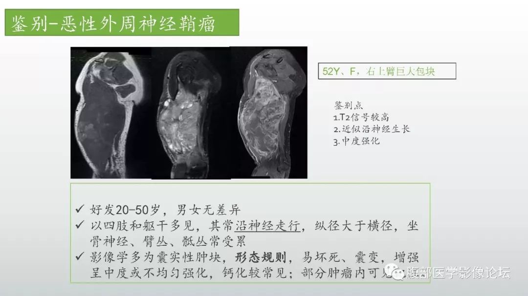 【病例】左下腹壁未分化多形性肉瘤1例CT影像