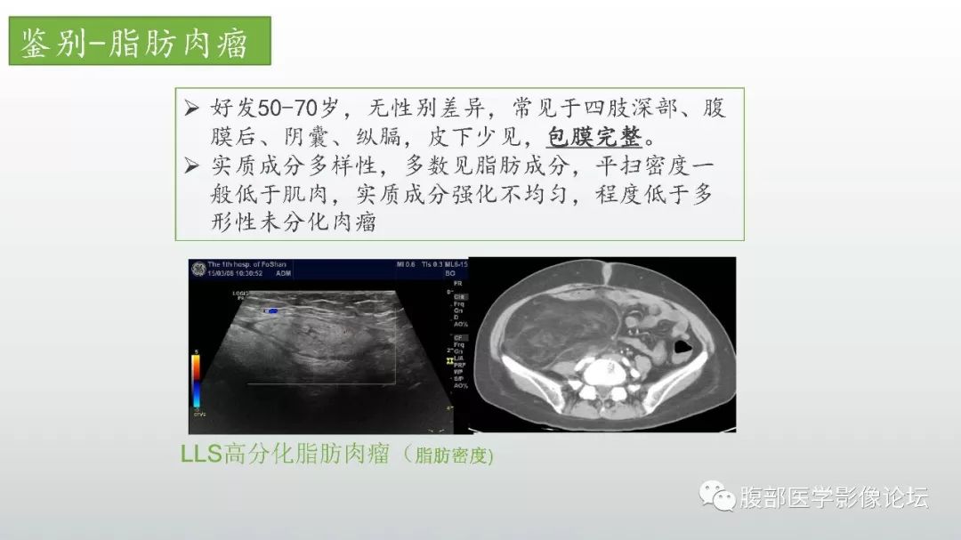 【病例】左下腹壁未分化多形性肉瘤1例CT影像