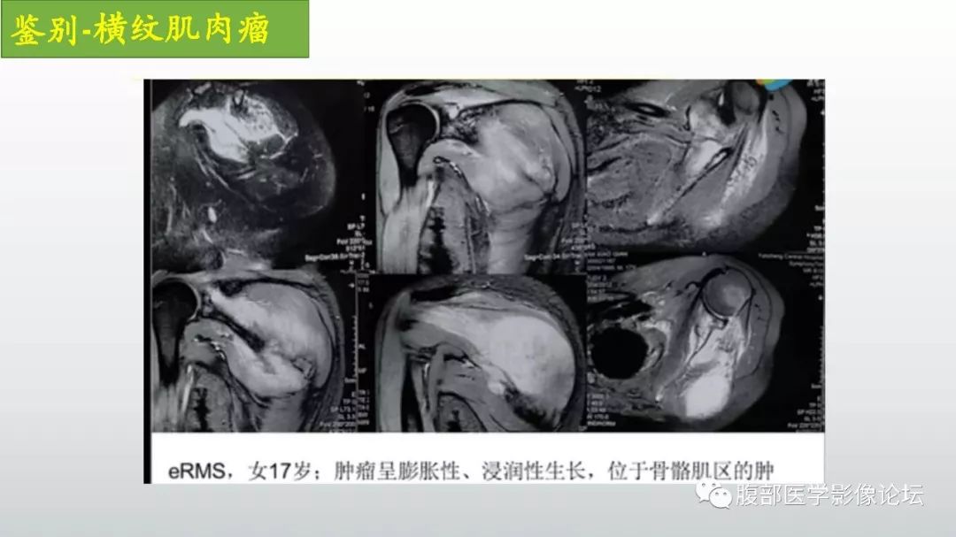 【病例】左下腹壁未分化多形性肉瘤1例CT影像