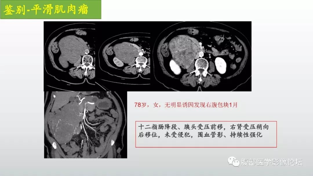 【病例】左下腹壁未分化多形性肉瘤1例CT影像
