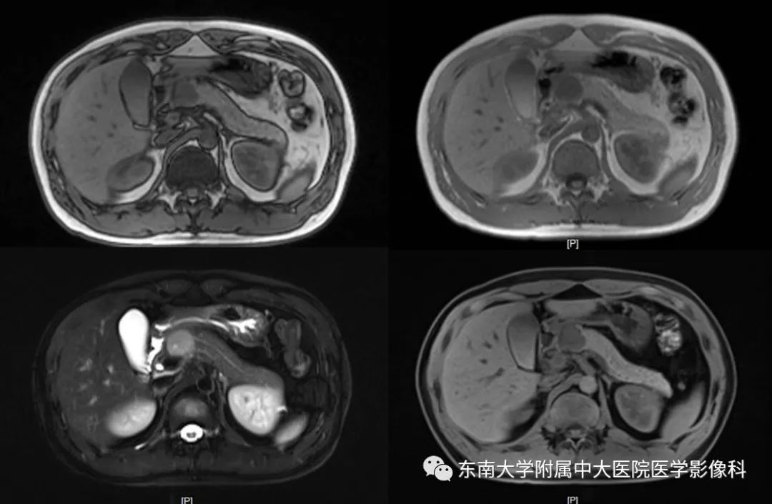 【PPT】胰腺实性乳头状上皮性肿瘤的影像