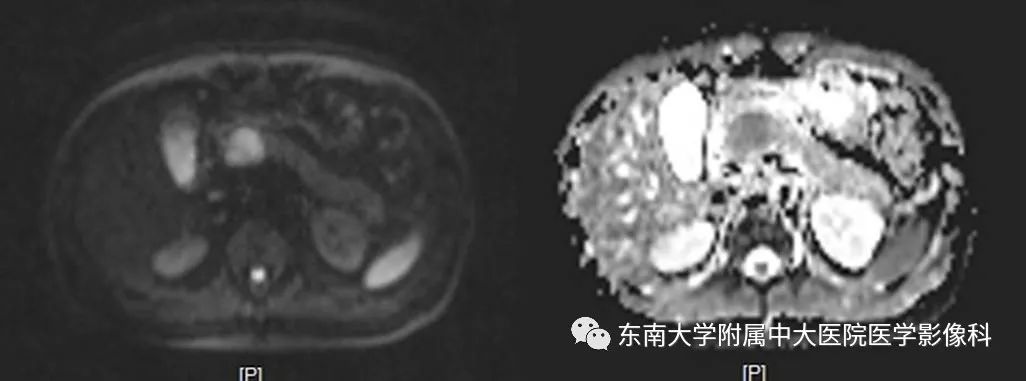 【PPT】胰腺实性乳头状上皮性肿瘤的影像