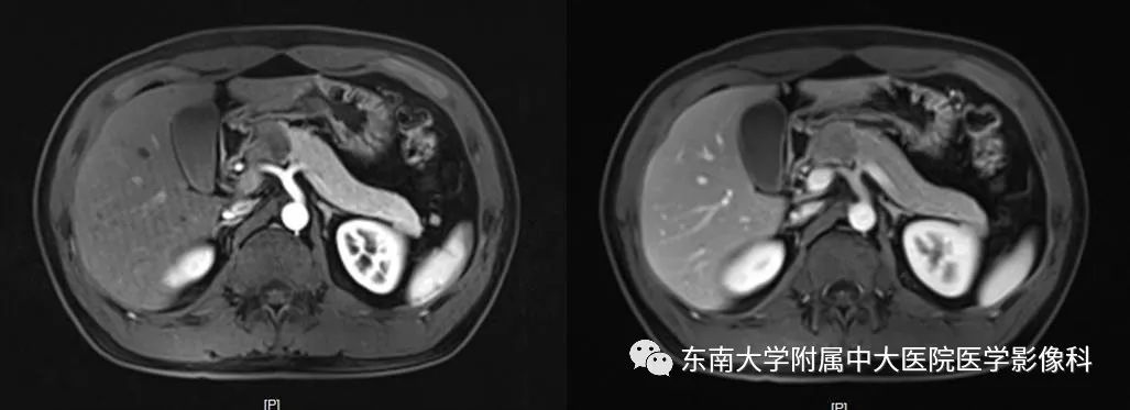 【PPT】胰腺实性乳头状上皮性肿瘤的影像