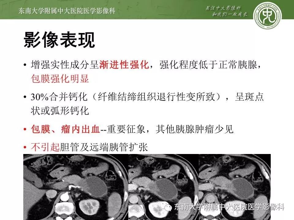 【PPT】胰腺实性乳头状上皮性肿瘤的影像