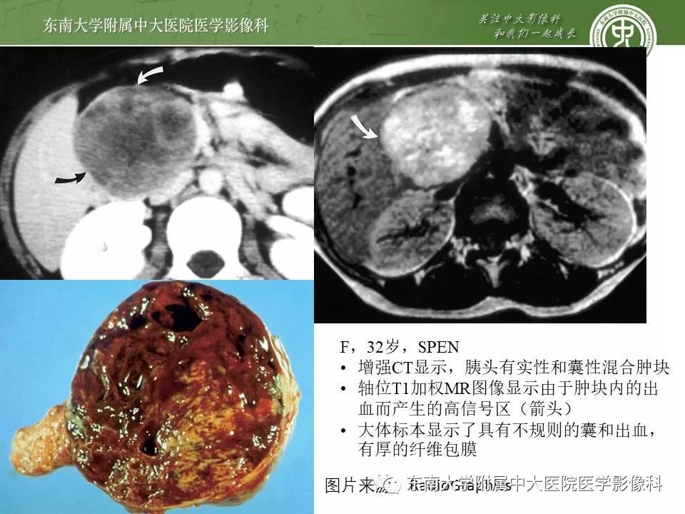 【PPT】胰腺实性乳头状上皮性肿瘤的影像