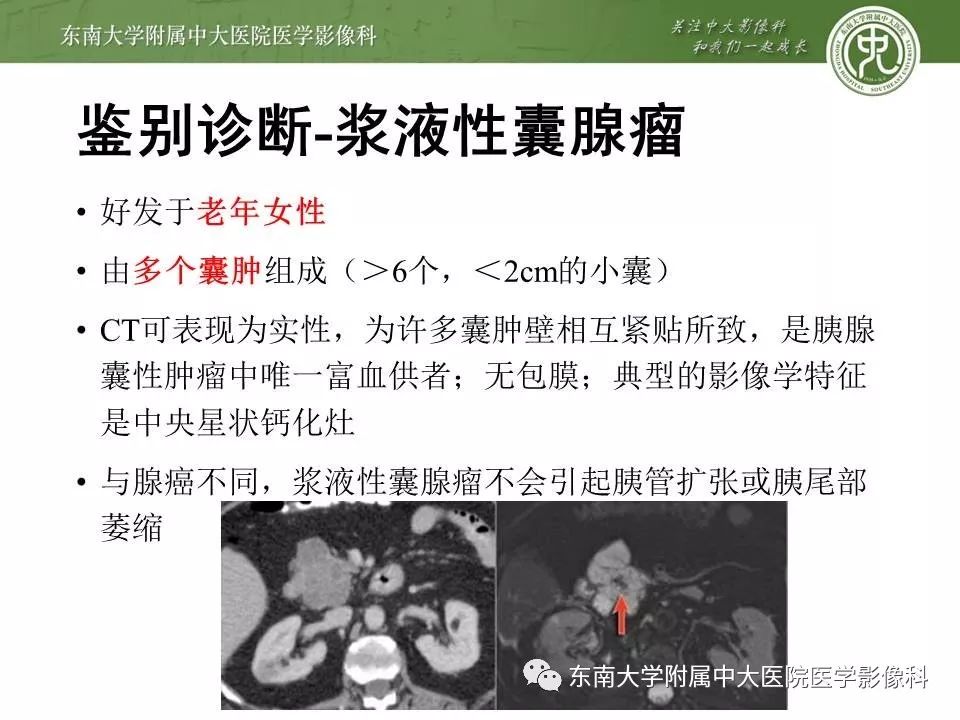 【PPT】胰腺实性乳头状上皮性肿瘤的影像
