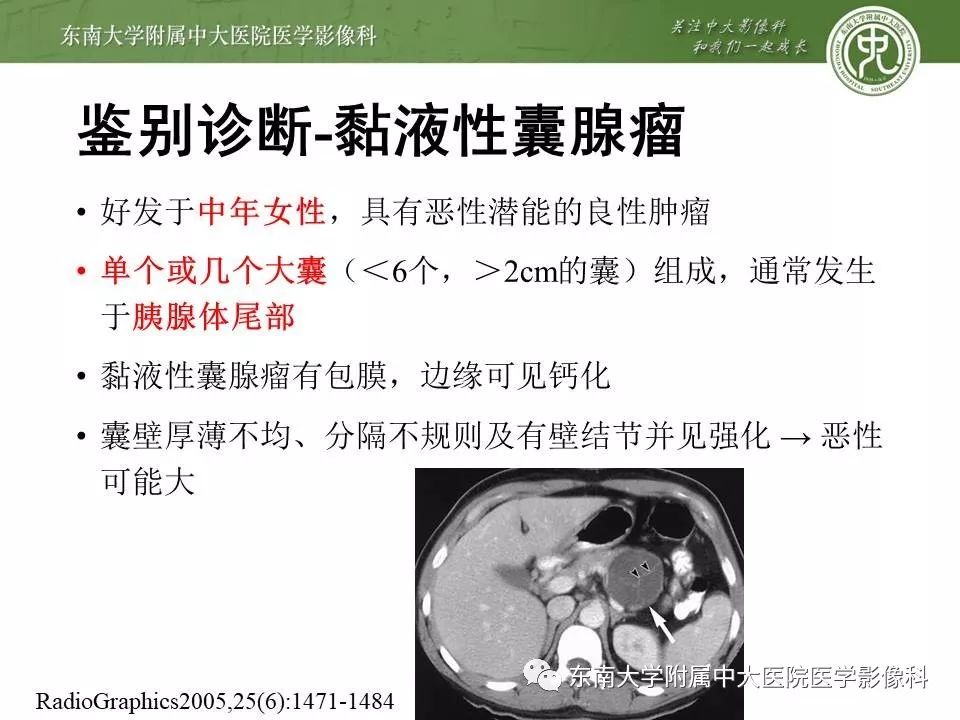 【PPT】胰腺实性乳头状上皮性肿瘤的影像