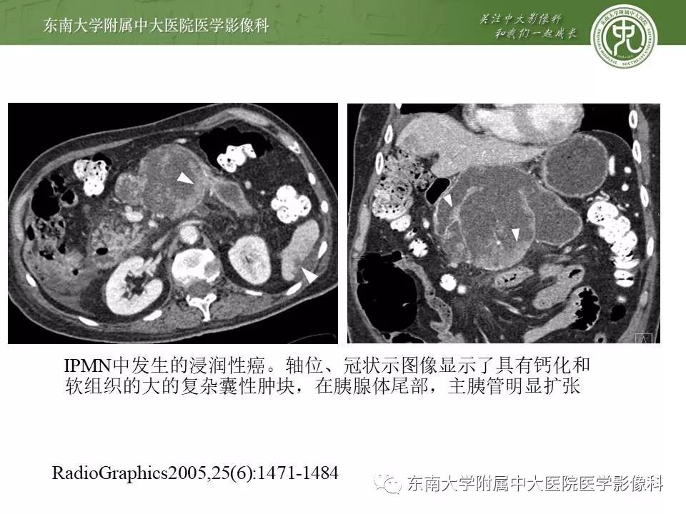 【PPT】胰腺实性乳头状上皮性肿瘤的影像