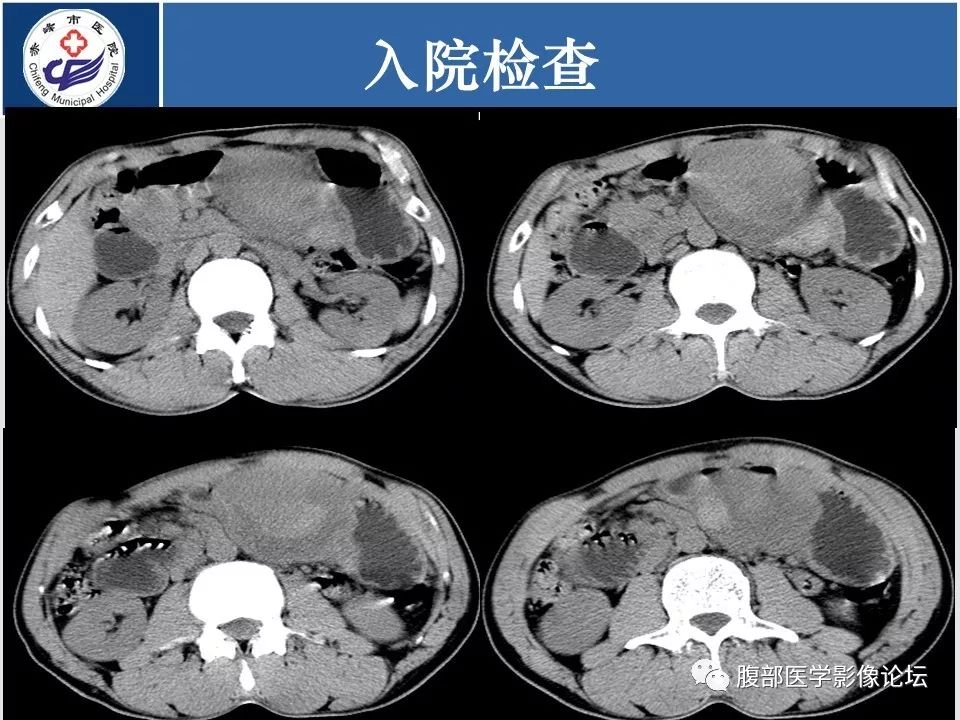 【病例】胃壁低度恶性纤维黏液样肉瘤1例CT影像