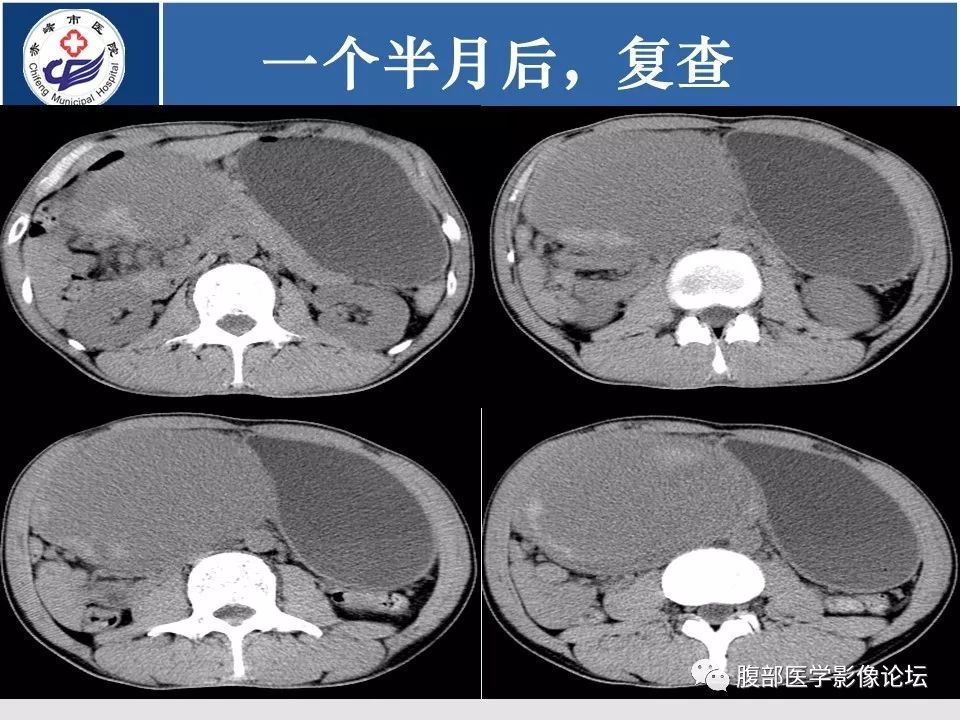 【病例】胃壁低度恶性纤维黏液样肉瘤1例CT影像