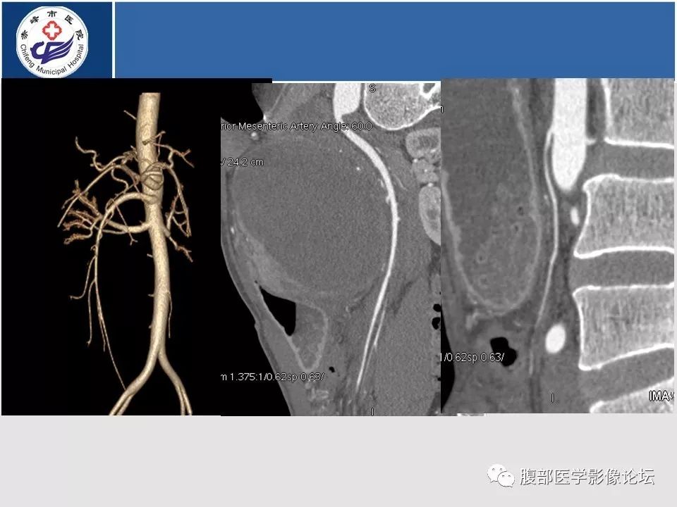 【病例】胃壁低度恶性纤维黏液样肉瘤1例CT影像