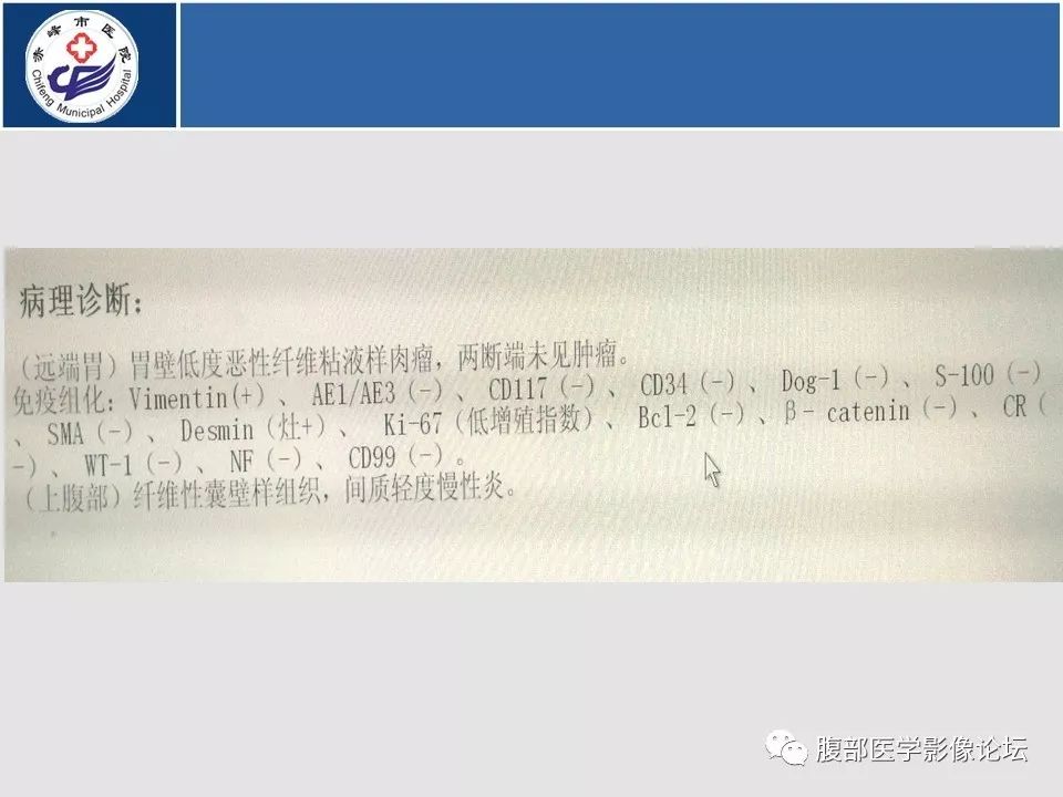 【病例】胃壁低度恶性纤维黏液样肉瘤1例CT影像
