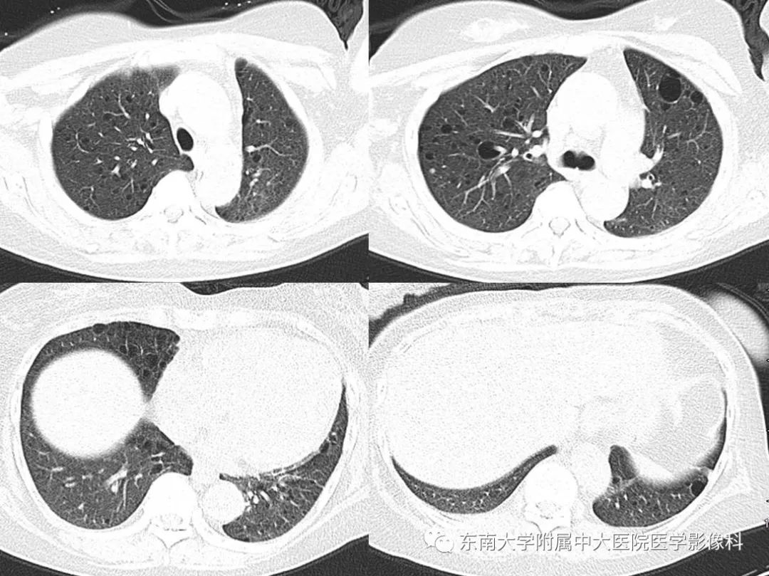 【PPT】肺淋巴管肌瘤病的影像