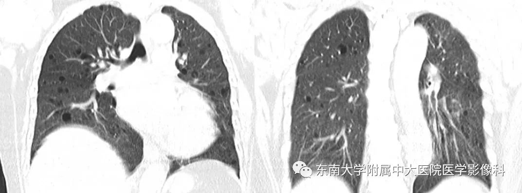 【PPT】肺淋巴管肌瘤病的影像