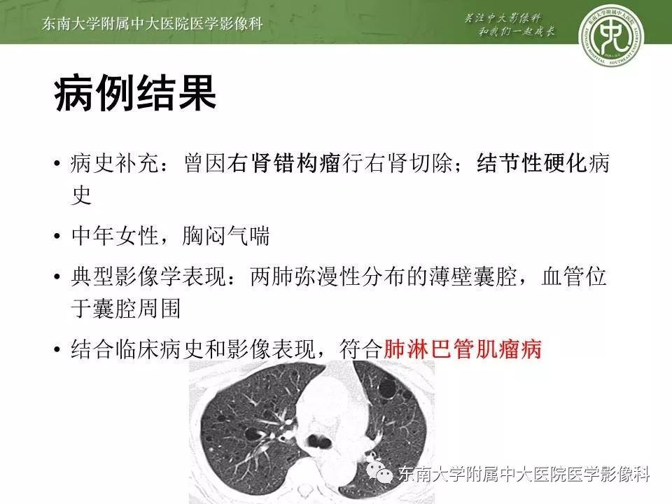 【PPT】肺淋巴管肌瘤病的影像