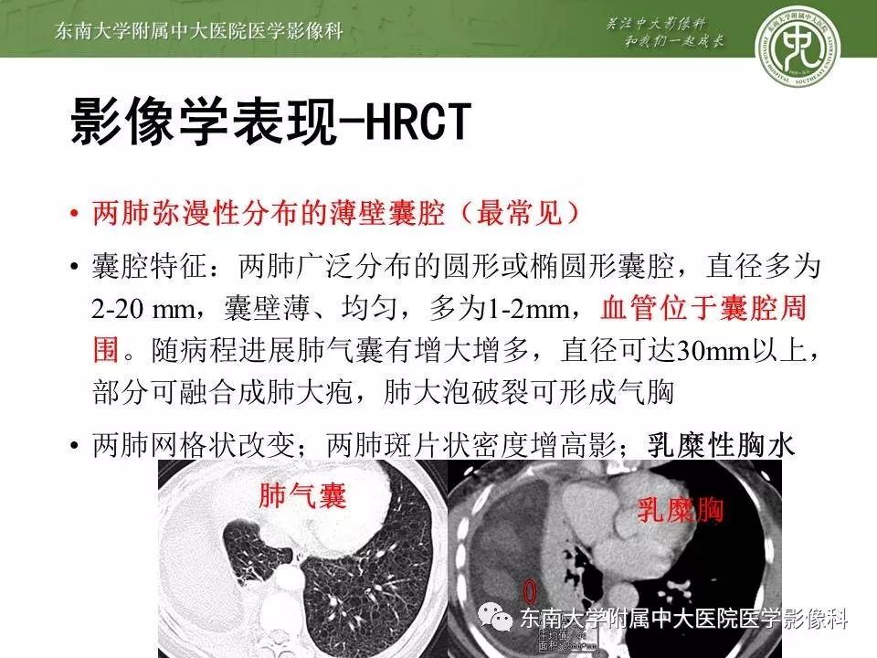 【PPT】肺淋巴管肌瘤病的影像